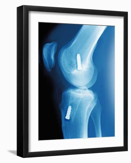 Anterior Cruciate Ligament Repair, X-ray-Miriam Maslo-Framed Photographic Print