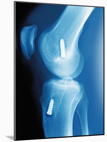 Anterior Cruciate Ligament Repair, X-ray-Miriam Maslo-Mounted Photographic Print