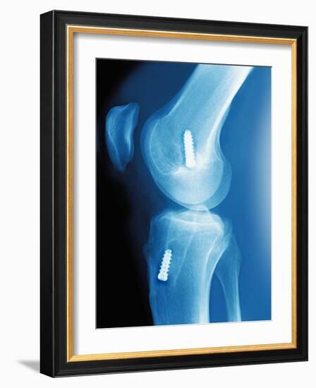 Anterior Cruciate Ligament Repair, X-ray-Miriam Maslo-Framed Photographic Print