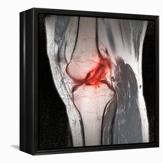 Anterior Cruciate Ligament Tear, CT Scan-Du Cane Medical-Framed Premier Image Canvas