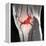 Anterior Cruciate Ligament Tear, CT Scan-Du Cane Medical-Framed Premier Image Canvas