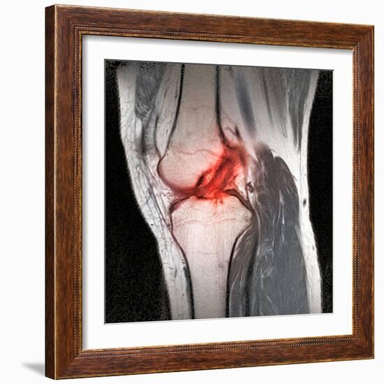 Anterior Cruciate Ligament Tear, CT Scan-Du Cane Medical-Framed Premium Photographic Print