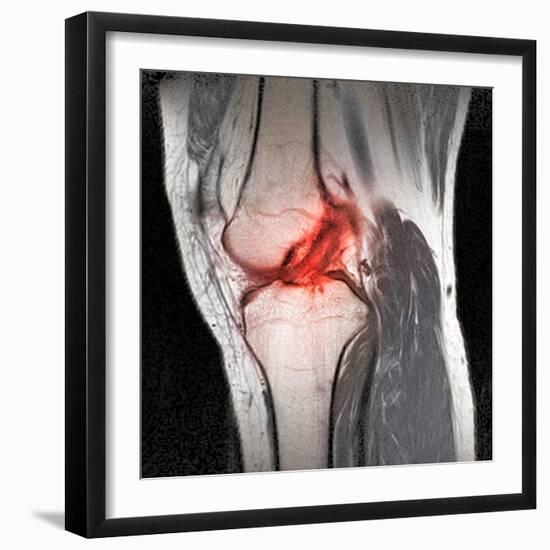 Anterior Cruciate Ligament Tear, CT Scan-Du Cane Medical-Framed Premium Photographic Print