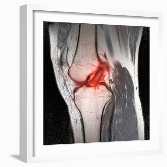 Anterior Cruciate Ligament Tear, CT Scan-Du Cane Medical-Framed Premium Photographic Print