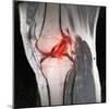 Anterior Cruciate Ligament Tear, CT Scan-Du Cane Medical-Mounted Premium Photographic Print