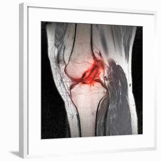 Anterior Cruciate Ligament Tear, CT Scan-Du Cane Medical-Framed Photographic Print