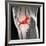 Anterior Cruciate Ligament Tear, CT Scan-Du Cane Medical-Framed Photographic Print