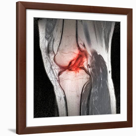 Anterior Cruciate Ligament Tear, CT Scan-Du Cane Medical-Framed Photographic Print