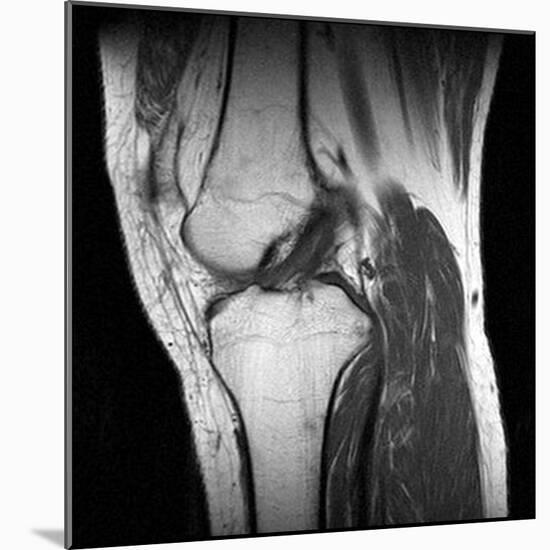 Anterior Cruciate Ligament Tear, CT Scan-Du Cane Medical-Mounted Photographic Print