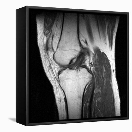 Anterior Cruciate Ligament Tear, CT Scan-Du Cane Medical-Framed Premier Image Canvas