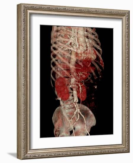 Aortic Aneurysm CT Scan-ZEPHYR-Framed Photographic Print