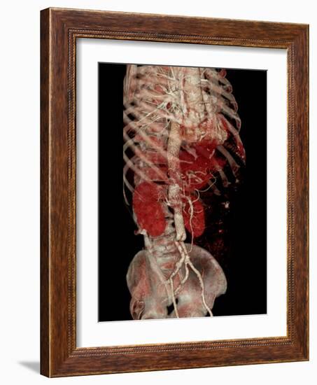 Aortic Aneurysm CT Scan-ZEPHYR-Framed Photographic Print