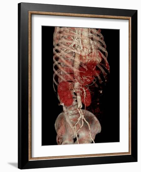 Aortic Aneurysm CT Scan-ZEPHYR-Framed Photographic Print