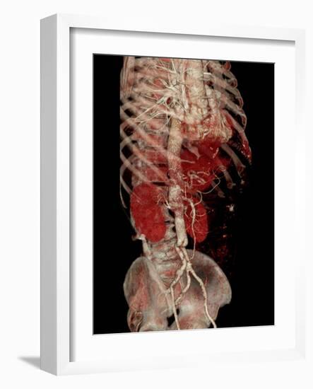 Aortic Aneurysm CT Scan-ZEPHYR-Framed Photographic Print