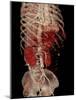 Aortic Aneurysm CT Scan-ZEPHYR-Mounted Photographic Print