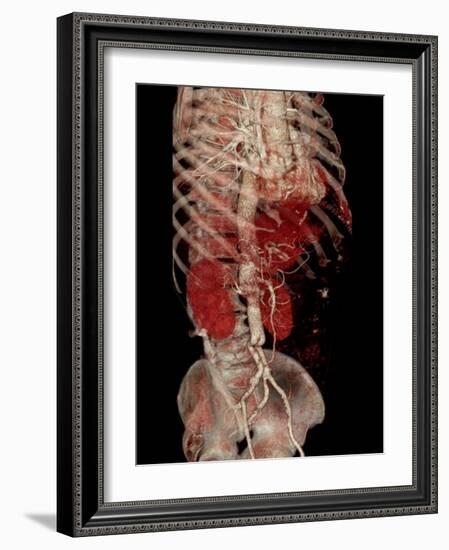 Aortic Aneurysm CT Scan-ZEPHYR-Framed Photographic Print