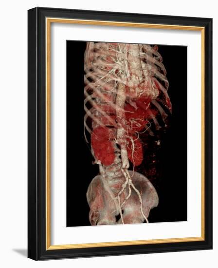 Aortic Aneurysm CT Scan-ZEPHYR-Framed Photographic Print