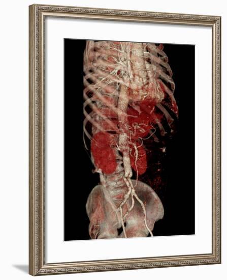 Aortic Aneurysm CT Scan-ZEPHYR-Framed Photographic Print