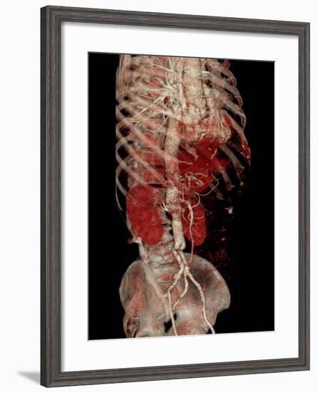 Aortic Aneurysm CT Scan-ZEPHYR-Framed Photographic Print