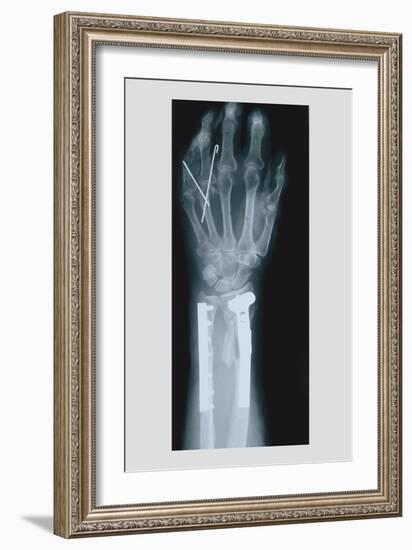 Arm and Finger Repair-null-Framed Art Print