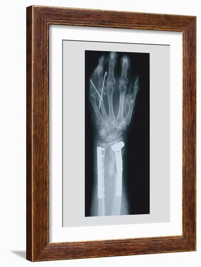 Arm and Finger Repair-null-Framed Art Print