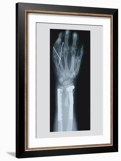 Arm and Finger Repair-null-Framed Art Print