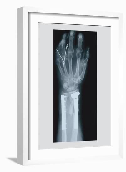 Arm and Finger Repair-null-Framed Art Print