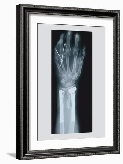 Arm and Finger Repair-null-Framed Art Print