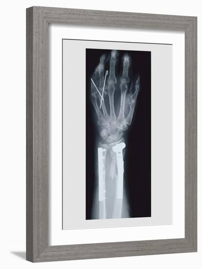 Arm and Finger Repair-null-Framed Premium Giclee Print