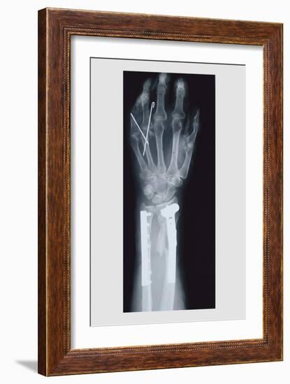 Arm and Finger Repair-null-Framed Premium Giclee Print