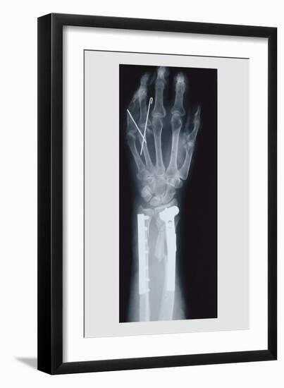 Arm and Finger Repair-null-Framed Premium Giclee Print