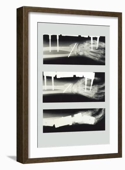 Arm with External Fixation-null-Framed Art Print