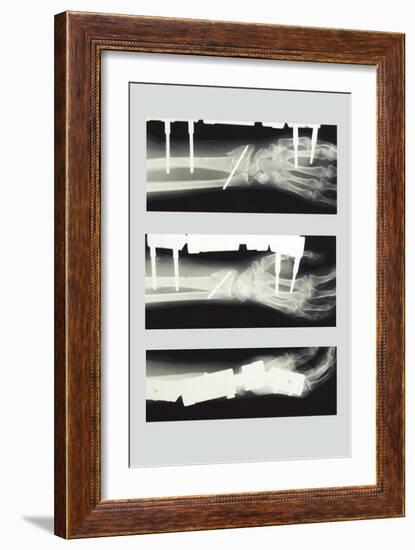 Arm with External Fixation-null-Framed Art Print