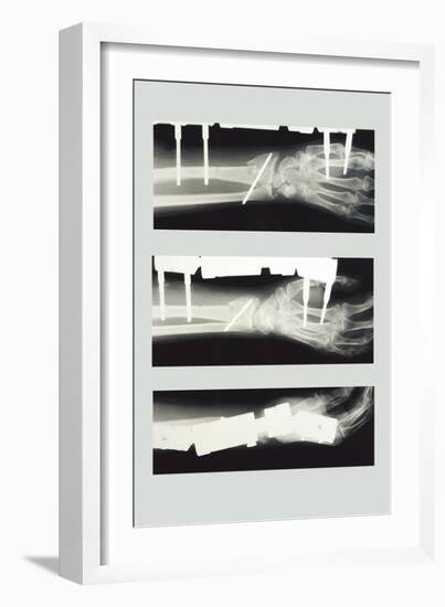 Arm with External Fixation-null-Framed Art Print