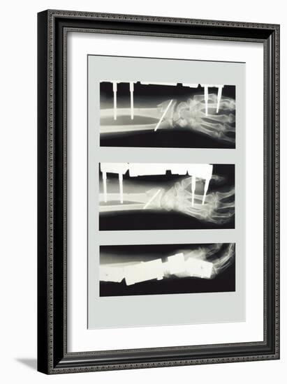 Arm with External Fixation-null-Framed Art Print