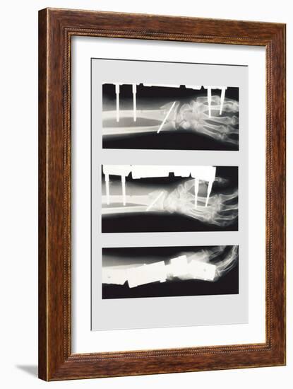 Arm with External Fixation-null-Framed Premium Giclee Print