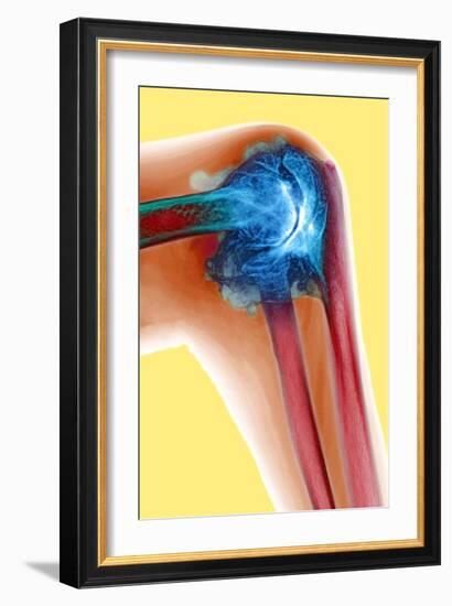 Arthritic Elbow, X-ray-Du Cane Medical-Framed Photographic Print