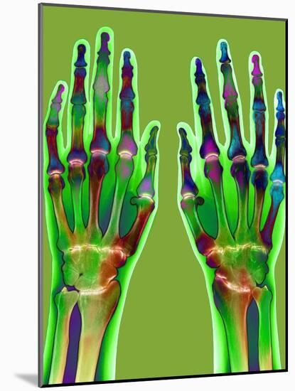 Arthritic Hands, X-ray-Du Cane Medical-Mounted Photographic Print