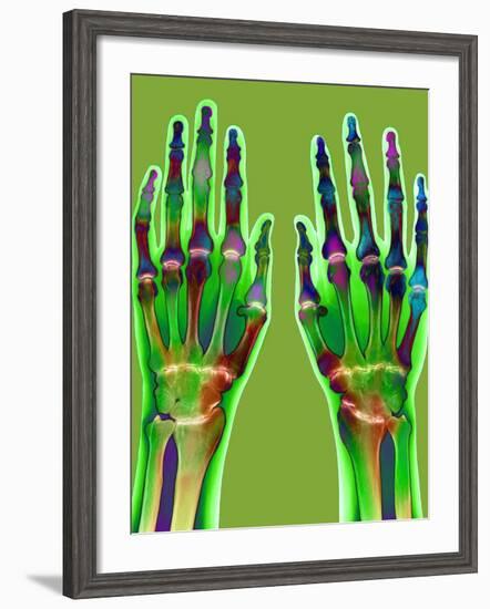 Arthritic Hands, X-ray-Du Cane Medical-Framed Photographic Print