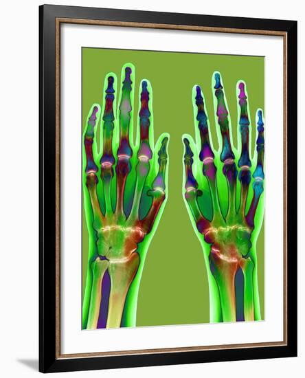 Arthritic Hands, X-ray-Du Cane Medical-Framed Photographic Print