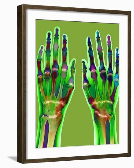 Arthritic Hands, X-ray-Du Cane Medical-Framed Photographic Print