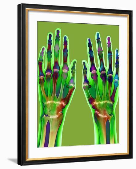 Arthritic Hands, X-ray-Du Cane Medical-Framed Photographic Print