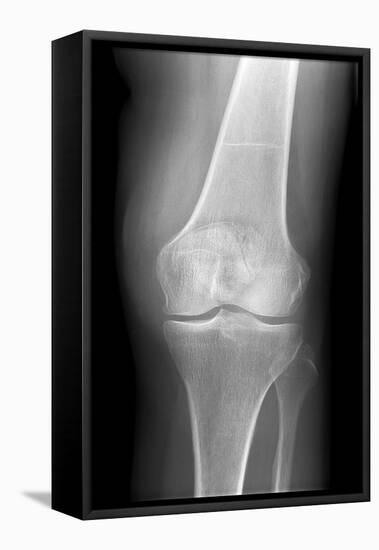 Arthritic Knee, X-ray-Du Cane Medical-Framed Premier Image Canvas
