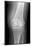 Arthritic Knee, X-ray-Du Cane Medical-Mounted Photographic Print