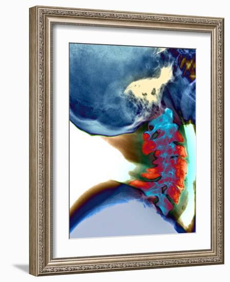 Arthritis In Neck, X-ray-Du Cane Medical-Framed Photographic Print
