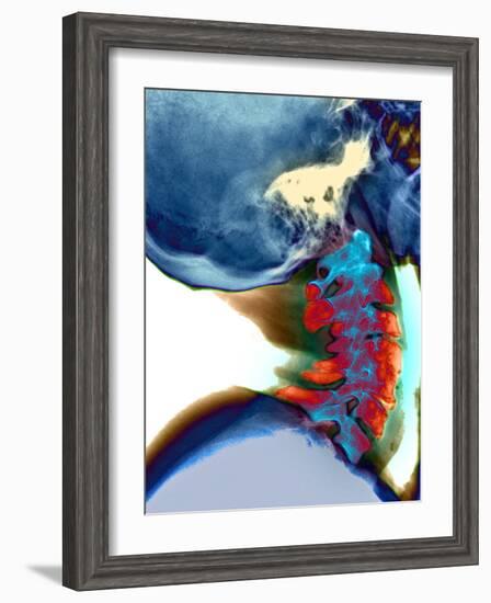 Arthritis In Neck, X-ray-Du Cane Medical-Framed Photographic Print