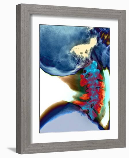 Arthritis In Neck, X-ray-Du Cane Medical-Framed Photographic Print