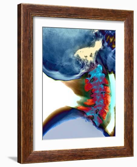 Arthritis In Neck, X-ray-Du Cane Medical-Framed Photographic Print