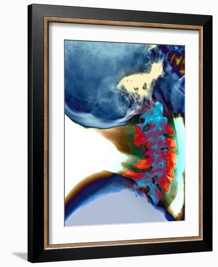 Arthritis In Neck, X-ray-Du Cane Medical-Framed Photographic Print