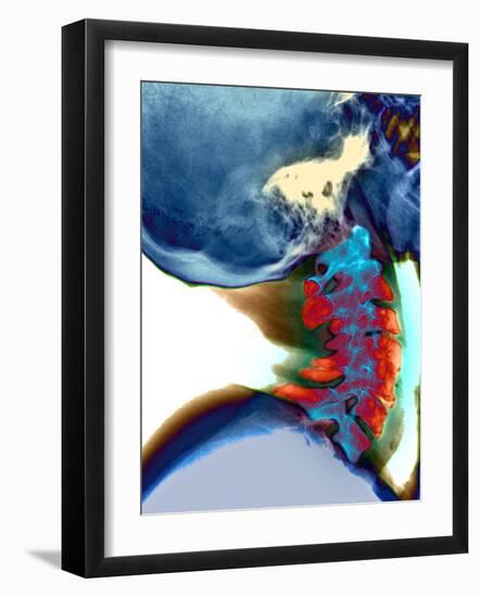 Arthritis In Neck, X-ray-Du Cane Medical-Framed Photographic Print